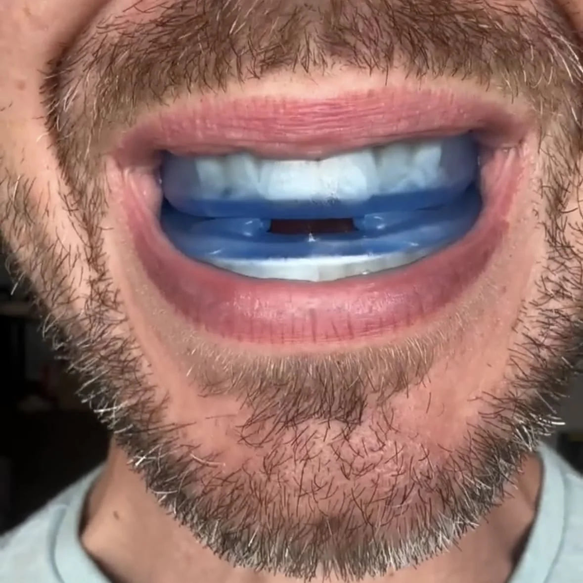 Honex™ Anti-Snoring Mouth Guard™